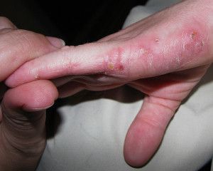 eczema on fingers