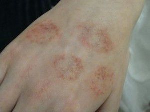 eczema on hands