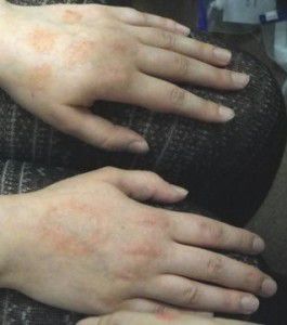 eczema on two hands