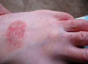 itchy dry skin patches