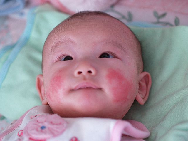 red baby eczema rashes
