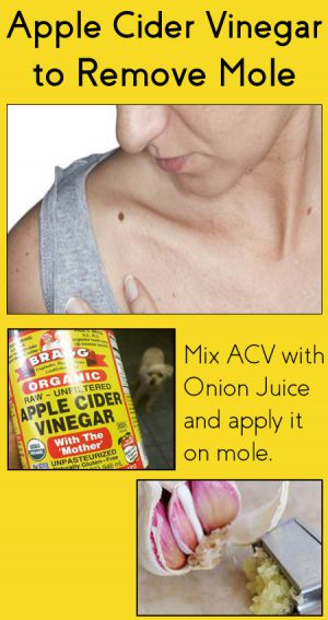 apple cider vinegar for mole removal