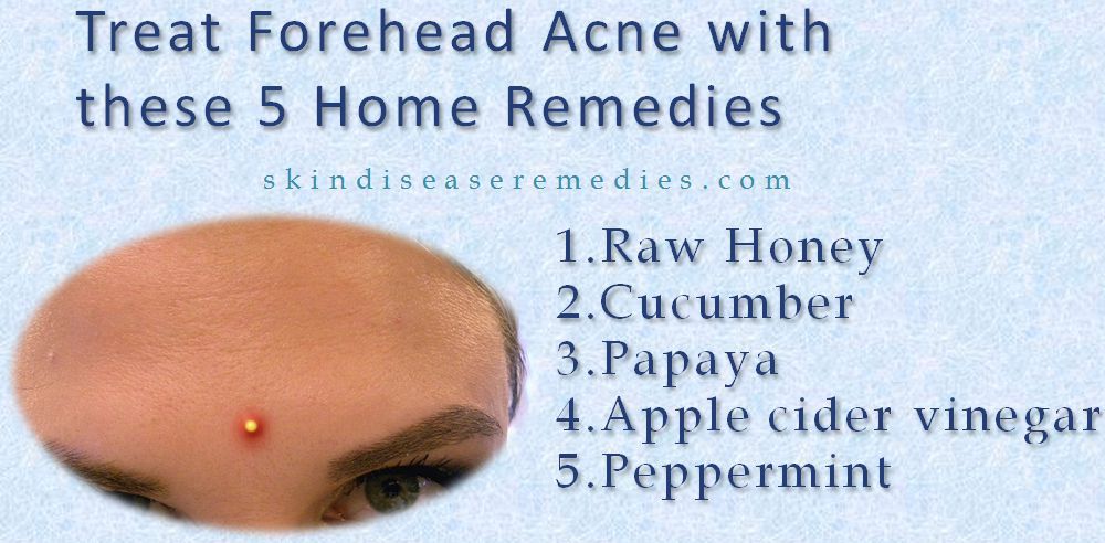 home remedies for forehead acne