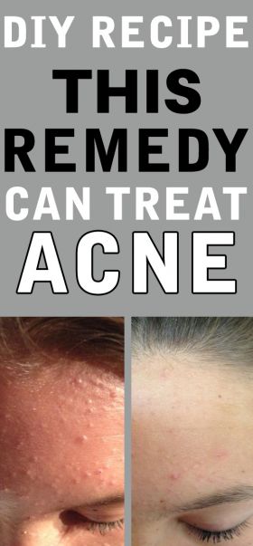How to Use Hydrogen Peroxide for Acne and Acne Scars – 12 Methods