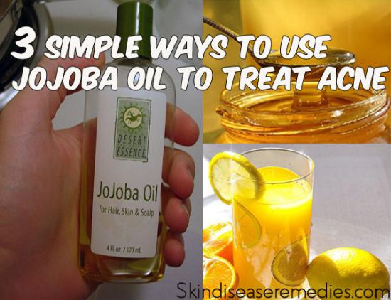 jojoba-oil-for-acne