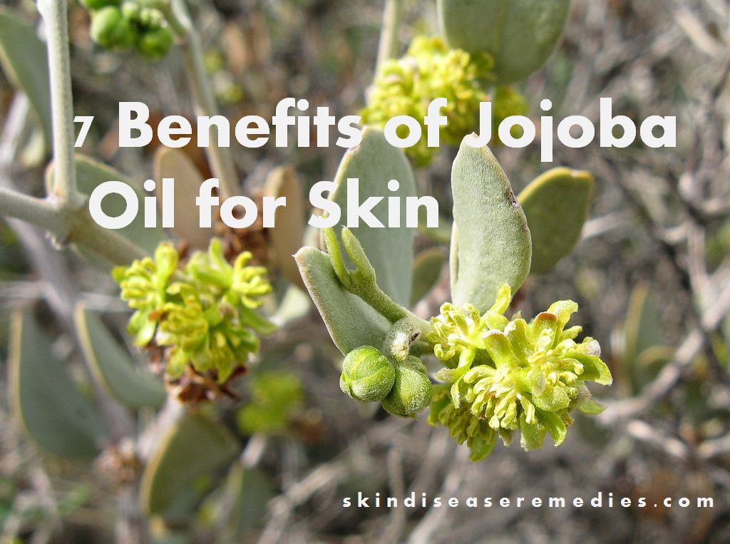 jojoba oil for acne