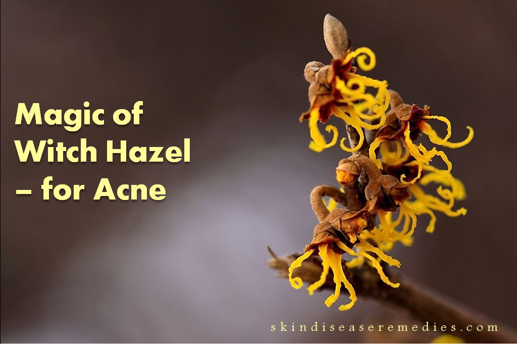 witch hazel for acne