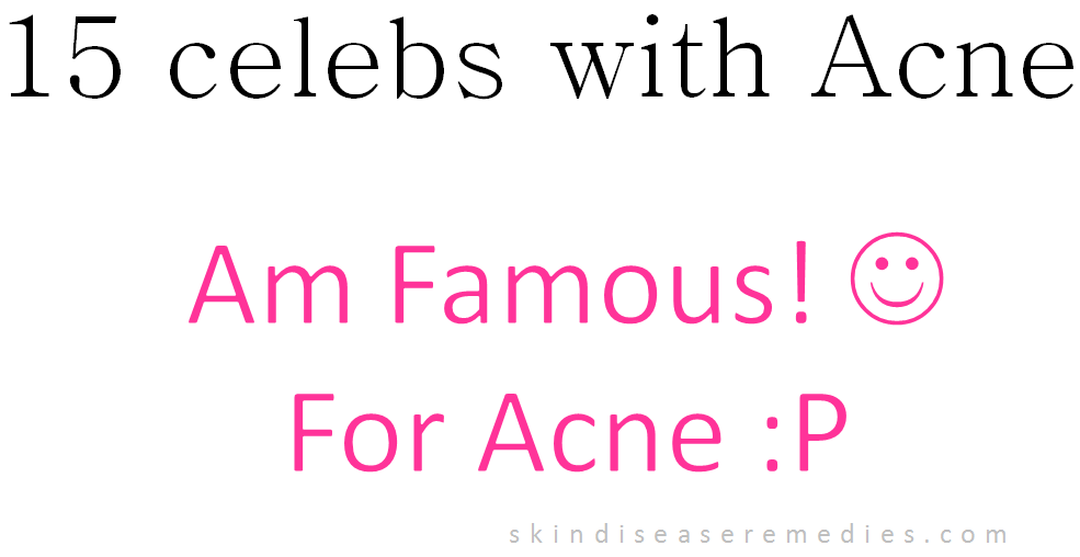 Celebrities with acne