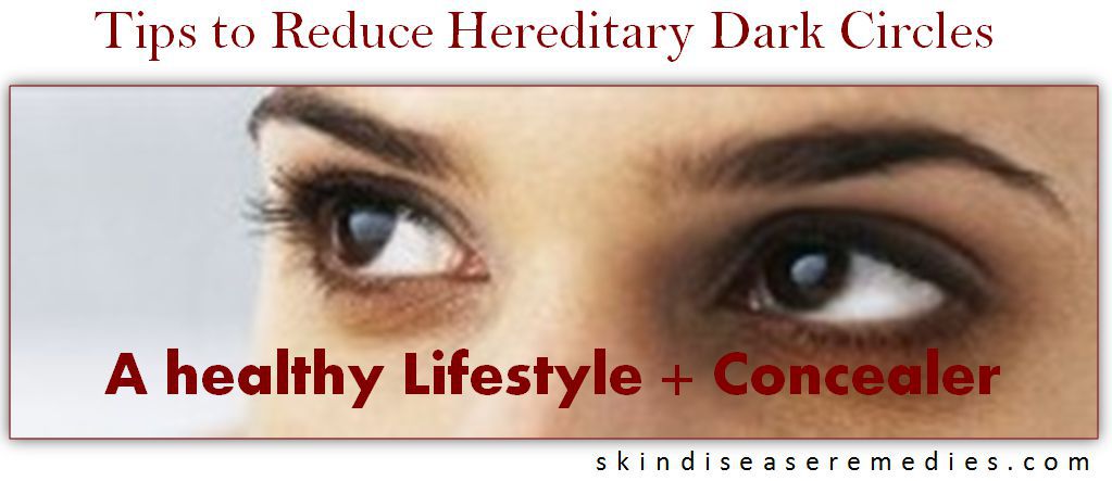 get rid of hereditray dark circles