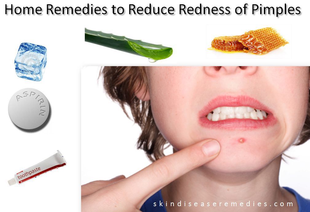how to reduce redness of pimples