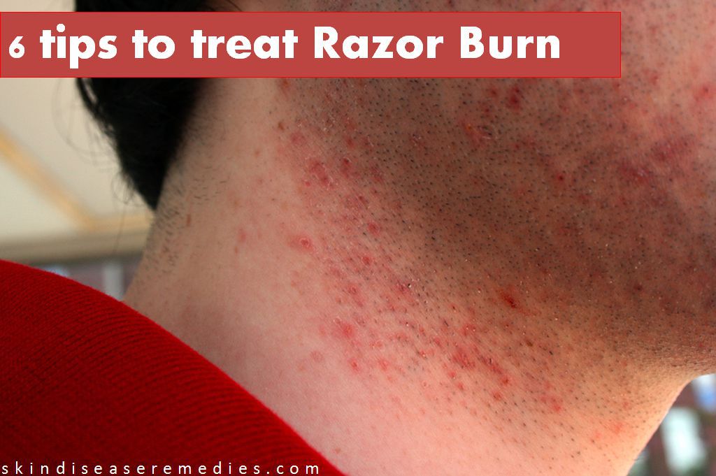 tips to get rid of razor burn