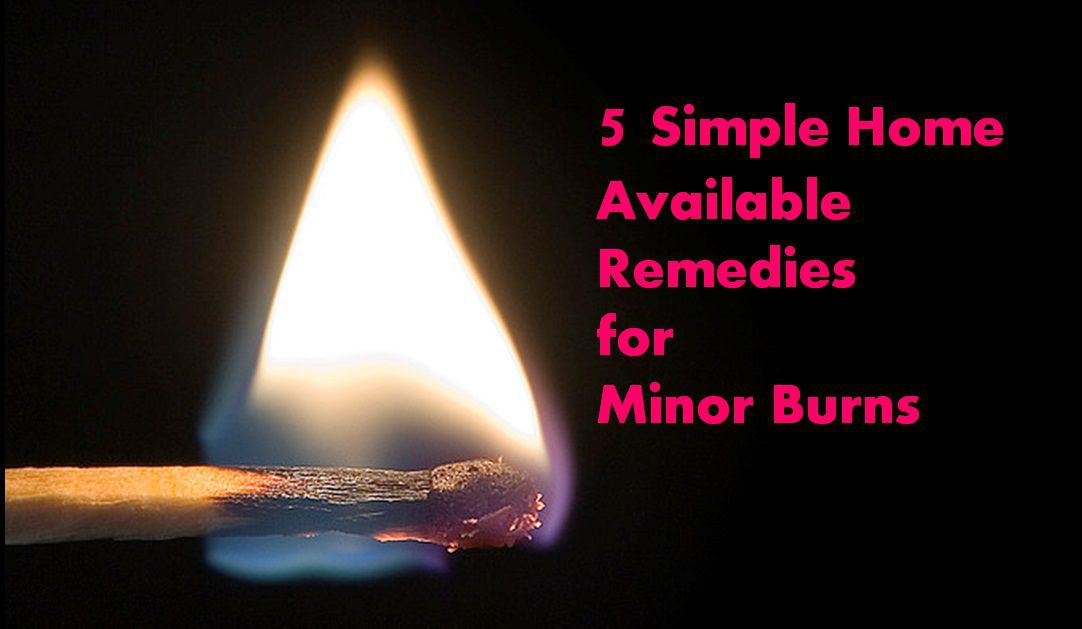 home remedies for minor burns