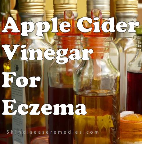 How to Use Apple Cider Vinegar for Eczema – 15 Treatment Methods