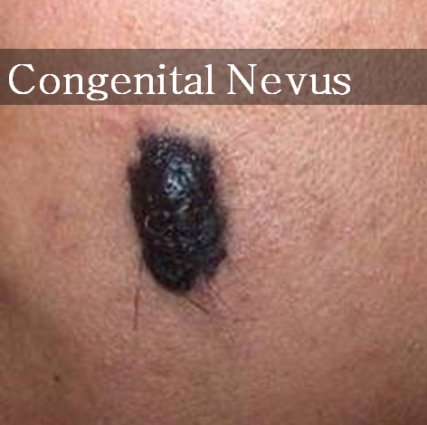 congenital nevi