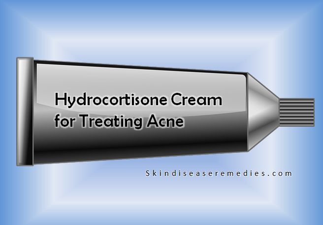 cortisone cream for acne