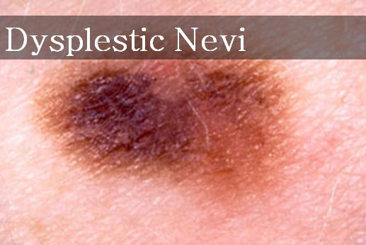 Different Types of Moles That You Must Know - Skin Disease Remedies