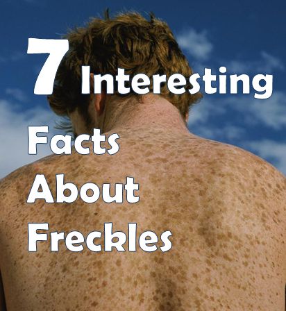 facts about freckles