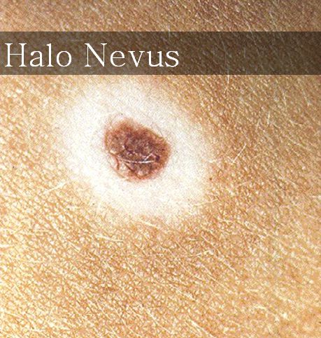 halo nevus