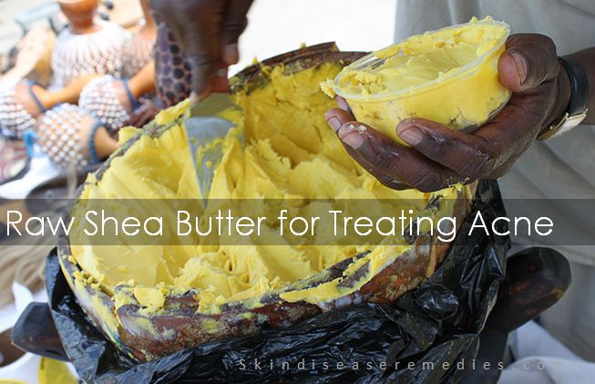 raw shea butter for treating acne