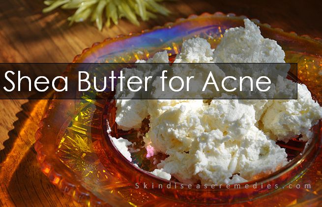 shea butter for treating acne