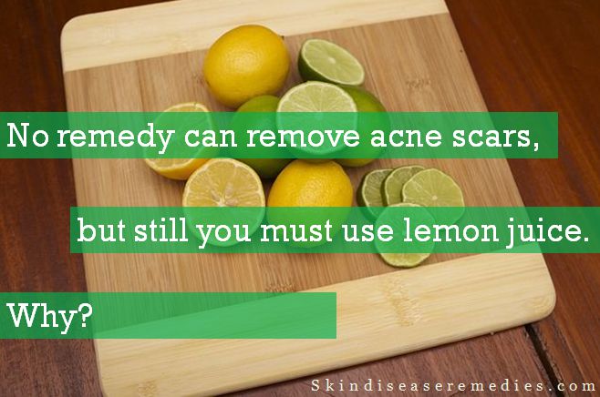 lemon juice for acne scars