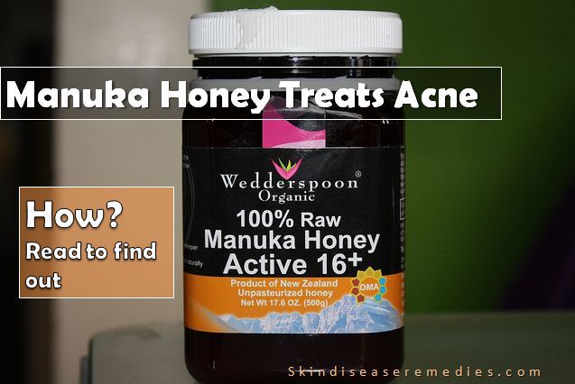 manuka honey for acne and ance scars