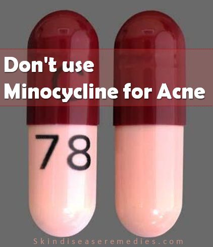 minocycline for acne