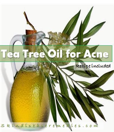 tea tree oil for treating acne