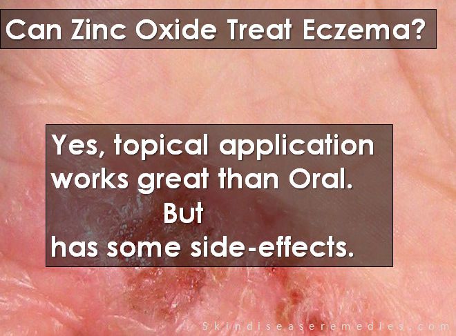 Zinc oxide side effects