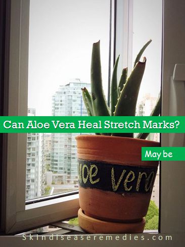 aloe vera for stretch marks
