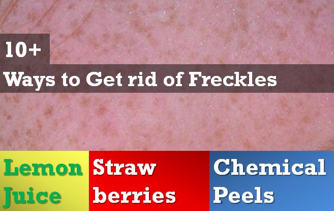 how to get rid of freckles