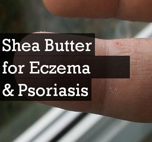 shea butter for eczema and psoriasis