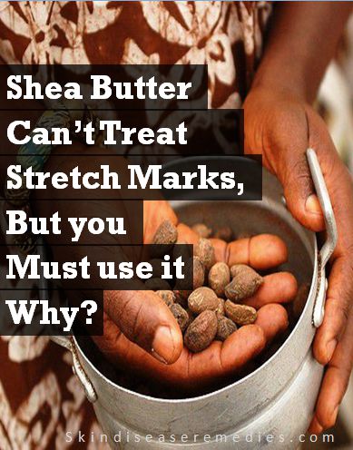 How to Use Raw Shea Butter for Stretch Marks (Before After Pregnancy)