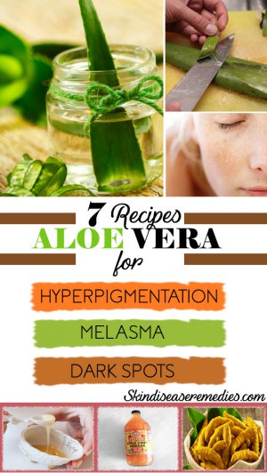 aloe vera for hyperpigmentation