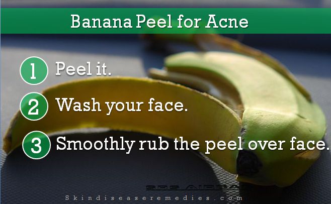 banana peel for acne