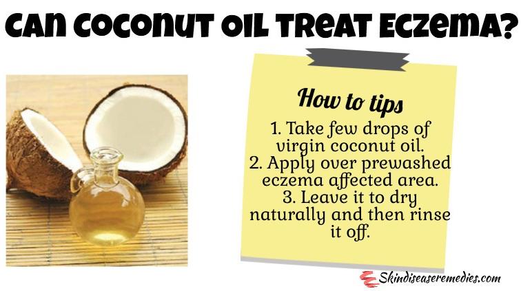 coconut oil for eczema and psoriasis