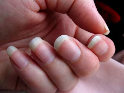 dent on fingernails