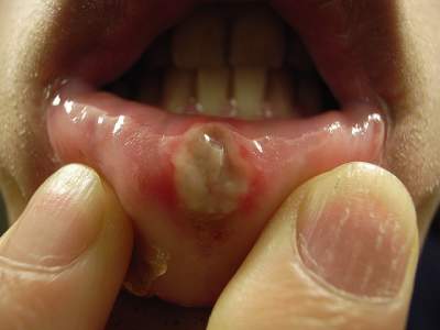 alum powder for canker sores