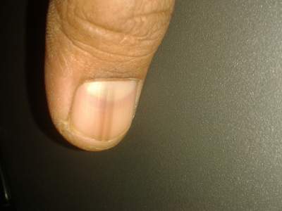 black lines on fingernails