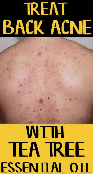How to Use Tea Tree Oil for Back Acne and Scars – 12 Methods
