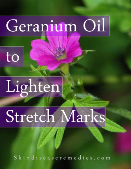 geranium oil to treat stretch marks
