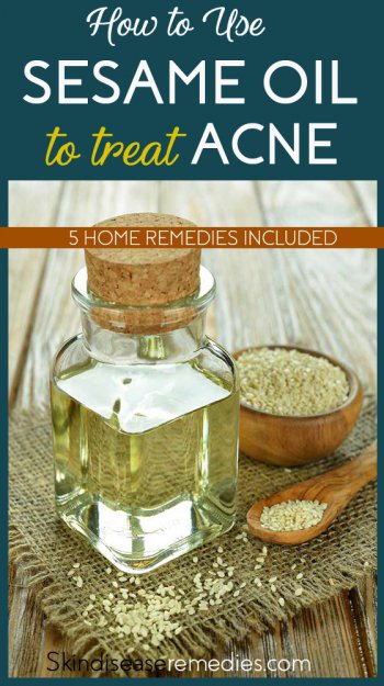 sesame oil for acne
