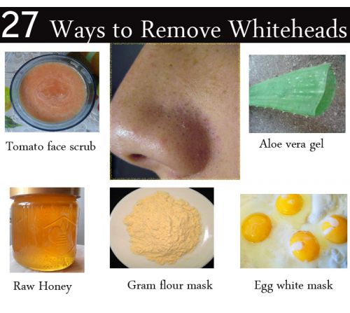 How to Get Rid of Whiteheads on Nose at Home – 27 Methods Included
