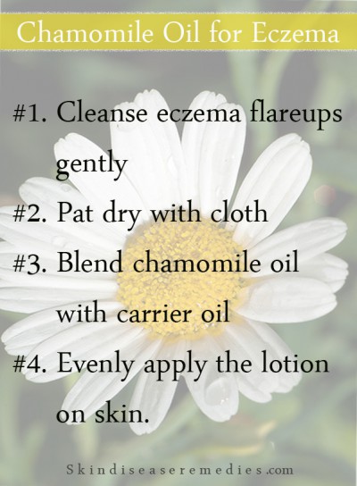 chamomile oil for eczema