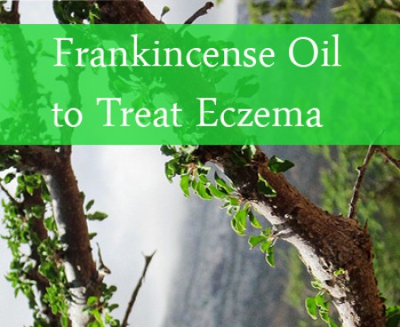 frankincense oil for eczema