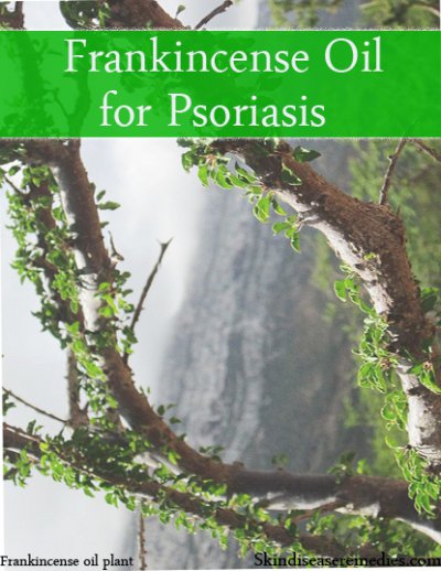 frankincense oil for psoriasis