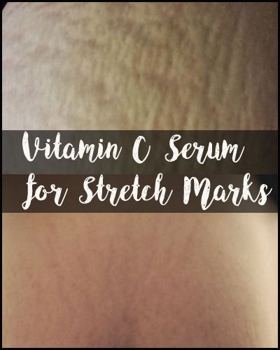 vitamin c for stretch marks