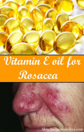 vitamin e oil for rosacea