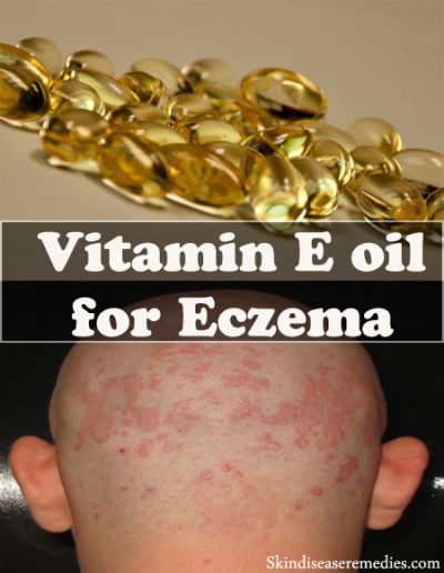 How to Use Vitamin E Oil for Eczema – 6 Awesome Ways