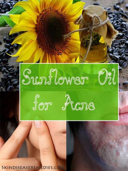 sunflower oil for acne